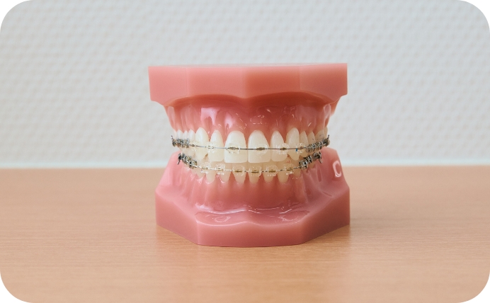 表側矯正のイメージ画像