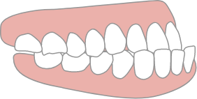 受け口のイメージ画像