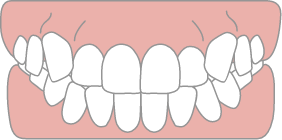 歯の捻れのイメージ画像
